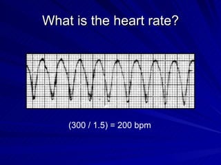 What is the heart rate? (300 / 1.5) = 200 bpm 