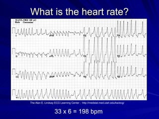 What is the heart rate? 33 x 6 = 198 bpm The Alan E. Lindsay ECG Learning Center ;  http://medstat.med.utah.edu/kw/ecg/ 