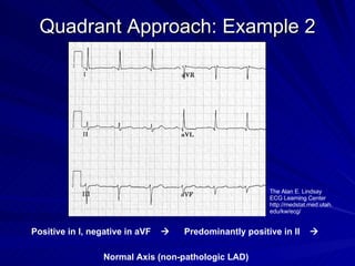 Quadrant Approach: Example 2 Positive in I, negative in aVF     Predominantly positive in II     Normal Axis (non-pathologic LAD) The Alan E. Lindsay ECG Learning Center http://medstat.med.utah.edu/kw/ecg/ 