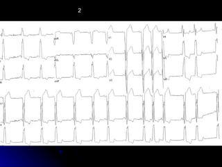 EKG Module | PPT