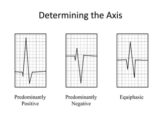 Determining the Axis
Predominantly
Positive
Predominantly
Negative
Equiphasic
 