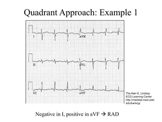 Quadrant Approach: Example 1
Negative in I, positive in aVF  RAD
The Alan E. Lindsay
ECG Learning Center
http://medstat.med.utah.
edu/kw/ecg/
 