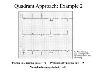 Quadrant Approach: Example 2
Positive in I, negative in aVF  Predominantly positive in II 
Normal Axis (non-pathologic LAD)
The Alan E. Lindsay
ECG Learning Center
http://medstat.med.utah.
edu/kw/ecg/
 