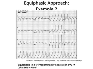 Equiphasic Approach:
Example 2
Equiphasic in II  Predominantly negative in aVL 
QRS axis ≈ +150°
The Alan E. Lindsay ECG Learning Center ; http://medstat.med.utah.edu/kw/ecg/
 