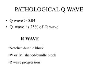 PATHOLOGICAL Q WAVE
• Q wave > 0.04
• Q wave is 25% of R wave
R WAVE
•Notched-bundle block
•W or M shaped-bundle block
•R wave progression
 