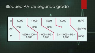 Bloqueo AV de segundo grado

 