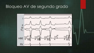 Bloqueo AV de segundo grado

 