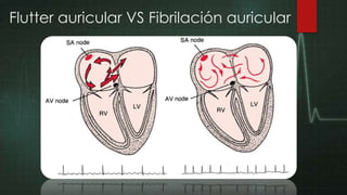 Flutter auricular VS Fibrilación auricular

 