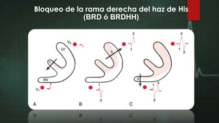 Bloqueo de la rama derecha del haz de His
(BRD ó BRDHH)

 