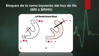 Bloqueo de la rama izquierda del haz de His
(BRI ó BRIHH)

 