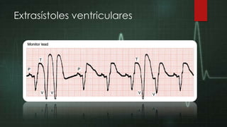 Extrasístoles ventriculares

 