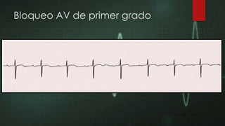 Bloqueo AV de primer grado

 