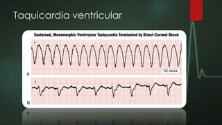 Taquicardia ventricular

 