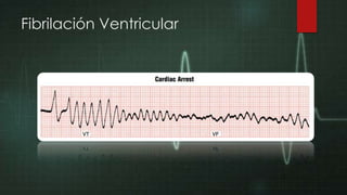 Fibrilación Ventricular

 
