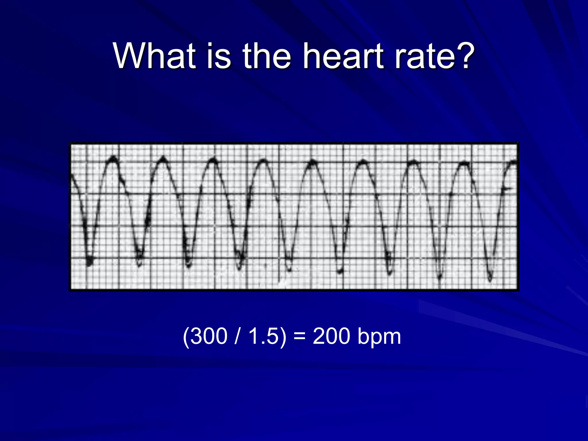 What is the heart rate?
(300 / 1.5) = 200 bpm
 