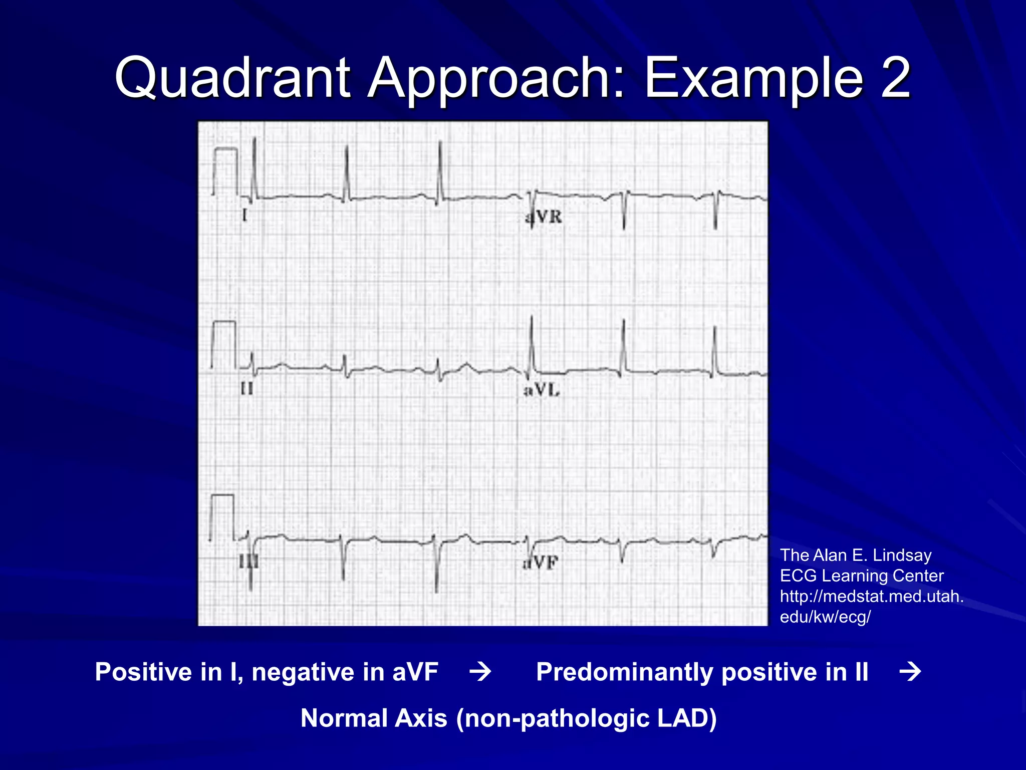 Quadrant Approach: Example 2
Positive in I, negative in aVF → Predominantly positive in II →
Normal Axis (non-pathologic LAD)
The Alan E. Lindsay
ECG Learning Center
http://medstat.med.utah.
edu/kw/ecg/
 