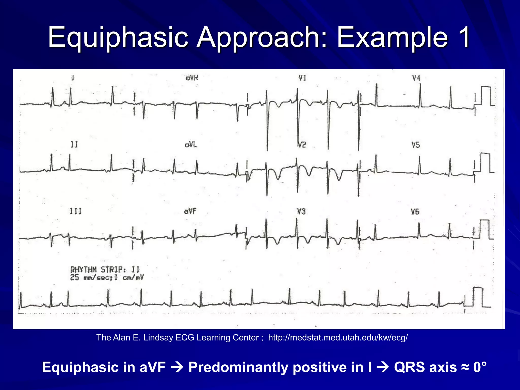 Equiphasic Approach: Example 1
Equiphasic in aVF → Predominantly positive in I → QRS axis ≈ 0°
The Alan E. Lindsay ECG Learning Center ; http://medstat.med.utah.edu/kw/ecg/
 
