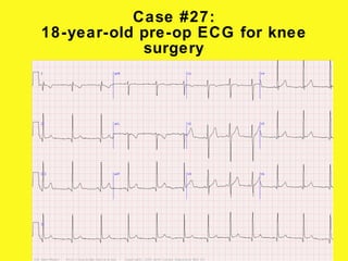 Case #27:
18-year-old pre-op ECG for knee
            surgery
 