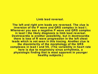 Limb lead reversal.

  The left and right arm leads are reversed. The clue is
   inversion of the P wave and QRS complex in lead I.
Whenever you see a negative P wave and QRS complex
    in lead I the likely diagnosis is limb lead reversal.
 Dextrocardia is another possibility, but in dextrocardia
   there is loss of R wave progression in the left chest
 leads which is not seen in this tracing. Another clue is
      the dissimilarity of the morphology of the QRS
complexes in lead I and V6. (The variability in heart rate
       here is due to respiratory sinus arrhythmia, a
   physiologic finding that is most apparent in younger
                      healthy subjects.)
 