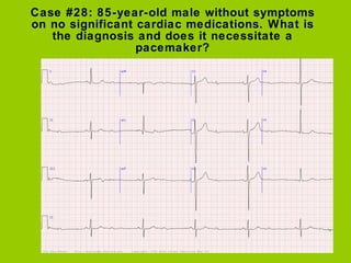 Case #28: 85-year-old male without symptoms
on no significant cardiac medications. What is
   the diagnosis and does it necessitate a
                  pacemaker?
 