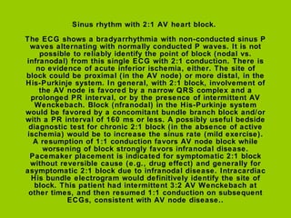 Sinus rhythm with 2:1 AV heart block.

The ECG shows a bradyarrhythmia with non-conducted sinus P
  waves alternating with normally conducted P waves. It is not
     possible to reliably identify the point of block (nodal vs.
infranodal) from this single ECG with 2:1 conduction. There is
    no evidence of acute inferior ischemia, either. The site of
block could be proximal (in the AV node) or more distal, in the
His-Purkinje system. In general, with 2:1 block, involvement of
     the AV node is favored by a narrow QRS complex and a
  prolonged PR interval, or by the presence of intermittent AV
   Wenckebach. Block (nfranodal) in the His-Purkinje system
would be favored by a concomitant bundle branch block and/or
with a PR interval of 160 ms or less. A possibly useful bedside
 diagnostic test for chronic 2:1 block (in the absence of active
 ischemia) would be to increase the sinus rate (mild exercise).
   A resumption of 1:1 conduction favors AV node block while
      worsening of block strongly favors infranodal disease.
  Pacemaker placement is indicated for symptomatic 2:1 block
  without reversible cause (e.g., drug effect) and generally for
asymptomatic 2:1 block due to infranodal disease. Intracardiac
  His bundle electrogram would definitively identify the site of
   block. This patient had intermittent 3:2 AV Wenckebach at
 other times, and then resumed 1:1 conduction on subsequent
            ECGs, consistent with AV node disease..
 