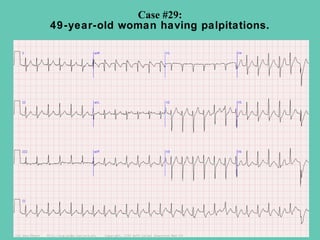 Case #29:
49-year-old woman having palpitations.
 