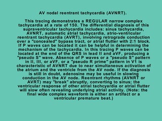 AV nodal reentrant tachycardia (AVNRT).

     This tracing demonstrates a REGULAR narrow complex
 tachycardia at a rate of 150. The differential diagnosis of this
    supraventricular tachycardia includes: sinus tachycardia,
      AVNRT, automatic atrial tachycardia, atrio-ventricular
reentrant tachycardia (AVRT), involving retrograde conduction
over a "concealed" bypass tract, or atrial flutter with 2:1 block.
 If P waves can be located it can be helpful in determining the
 mechanism of the tachycardia. In this tracing P waves can be
 located at the end of the QRS in lead II and aVF, producing a
"pseudo S" wave. Absence of P waves or a "pseudo S" pattern
     in II, III, or aVF, or a "pseudo R prime" pattern in V1 is
characteristic of AVNRT due to near simultaneous activation of
the atrium and the ventricle from the AV node. If the diagnosis
       is still in doubt, adenosine may be useful in slowing
    conduction in the AV node. Reentrant rhythms (AVNRT or
       AVRT) may "break" abruptly, converting to sinus; the
ventricular response of other atrial tachcyardia or atrial flutter
  will slow often revealing underlying atrial activity. (Note: the
      final wide complex waveform is either an artifact or a
                      ventricular premature beat.)
 