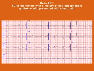 Case #31:
60-yr-old female with a history of anti-phospholipid
    syndrome who presented with chest pain.
 