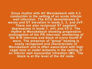 Sinus rhythm with AV Wenckebach with 4:3
 conduction in the setting of an acute inferior
    wall infarction. The ECG demonstrates Q
waves and ST elevation in leads 2, 3, and aVF.
     There are also reciprocal ST segment
   depressions in leads 1, aVL and V2-3. The
  rhythm is Wenckebach showing progressive
prolongation of the PR intervals, shortening of
 the R-R intervals and block of every fourth P
    wave. The presence of "group" beating is
     easily recognized and characteristic of
Wenckebach and is often associated with high
 vagal tone or nodal ischemia in the setting of
an inferior wall myocardial infraction (MI). The
      block is at the level of the AV node.
 