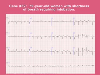 Case #32: 79-year-old woman with shortness
       of breath requiring intubation.
 