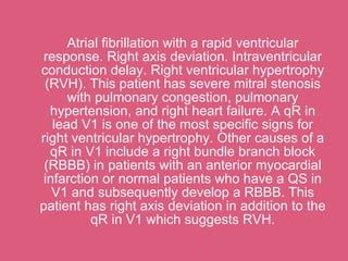 Atrial fibrillation with a rapid ventricular
 response. Right axis deviation. Intraventricular
conduction delay. Right ventricular hypertrophy
 (RVH). This patient has severe mitral stenosis
      with pulmonary congestion, pulmonary
  hypertension, and right heart failure. A qR in
   lead V1 is one of the most specific signs for
right ventricular hypertrophy. Other causes of a
  qR in V1 include a right bundle branch block
 (RBBB) in patients with an anterior myocardial
 infarction or normal patients who have a QS in
   V1 and subsequently develop a RBBB. This
patient has right axis deviation in addition to the
          qR in V1 which suggests RVH.
 