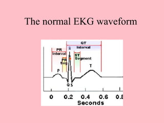 The normal EKG waveform
 