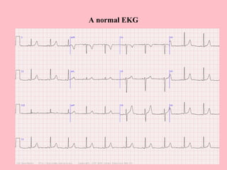 A normal EKG
 