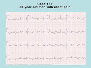 Case #33:
58-year-old man with chest pain.
 