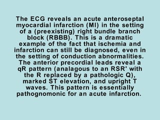 The ECG reveals an acute anteroseptal
 myocardial infarction (MI) in the setting
   of a (preexisting) right bundle branch
      block (RBBB). This is a dramatic
  example of the fact that ischemia and
infarction can still be diagnosed, even in
 the setting of conduction abnormalities.
  The anterior precordial leads reveal a
  qR pattern (analagous to an RSR' with
    the R replaced by a pathologic Q),
    marked ST elevation, and upright T
     waves. This pattern is essentially
 pathognomonic for an acute infarction.
 