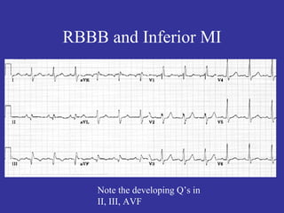 RBBB and Inferior MI




    Note the developing Q’s in
    II, III, AVF
 