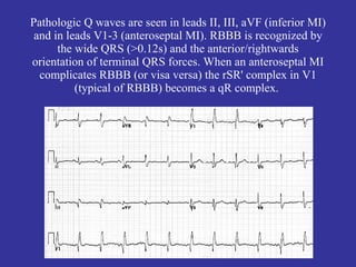Pathologic Q waves are seen in leads II, III, aVF (inferior MI)
 and in leads V1-3 (anteroseptal MI). RBBB is recognized by
      the wide QRS (>0.12s) and the anterior/rightwards
orientation of terminal QRS forces. When an anteroseptal MI
  complicates RBBB (or visa versa) the rSR' complex in V1
          (typical of RBBB) becomes a qR complex.
 