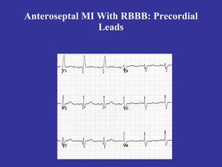 Anteroseptal MI With RBBB: Precordial
                Leads
 