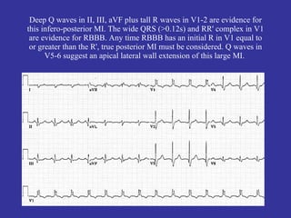 Deep Q waves in II, III, aVF plus tall R waves in V1-2 are evidence for
this infero-posterior MI. The wide QRS (>0.12s) and RR' complex in V1
 are evidence for RBBB. Any time RBBB has an initial R in V1 equal to
 or greater than the R', true posterior MI must be considered. Q waves in
      V5-6 suggest an apical lateral wall extension of this large MI.
 