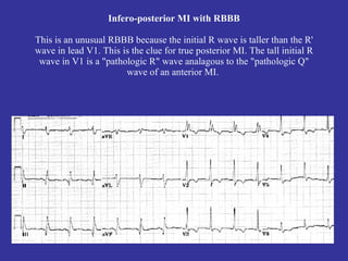 Infero-posterior MI with RBBB

This is an unusual RBBB because the initial R wave is taller than the R'
wave in lead V1. This is the clue for true posterior MI. The tall initial R
 wave in V1 is a "pathologic R" wave analagous to the "pathologic Q"
                       wave of an anterior MI.
 
