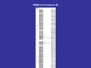 RBBB and Posterior MI
 