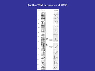 Another TPMI in presence of RBBB
 
