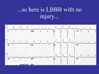 ...so here is LBBB with no
           injury...
 