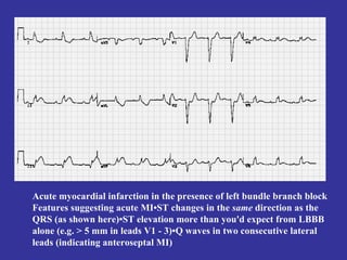 Acute myocardial infarction in the presence of left bundle branch block
Features suggesting acute MI•ST changes in the same direction as the
QRS (as shown here)•ST elevation more than you'd expect from LBBB
alone (e.g. > 5 mm in leads V1 - 3)•Q waves in two consecutive lateral
leads (indicating anteroseptal MI)
 