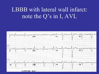 LBBB with lateral wall infarct:
   note the Q’s in I, AVL
 