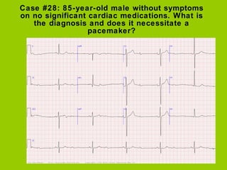 Sinus rhythm with 2:1 AV heart block.

The ECG shows a bradyarrhythmia with non-conducted sinus P
  waves alternating with...