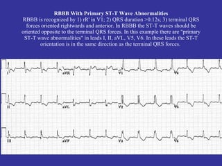 RBBB and Inferior MI




    Note the developing Q’s in
    II, III, AVF
 
