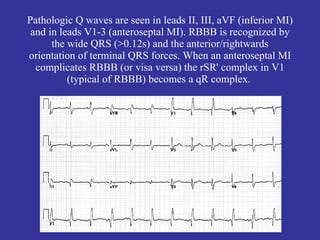 Deep Q waves in II, III, aVF plus tall R waves in V1-2 are evidence for
this infero-posterior MI. The wide QRS (>0.12s) an...