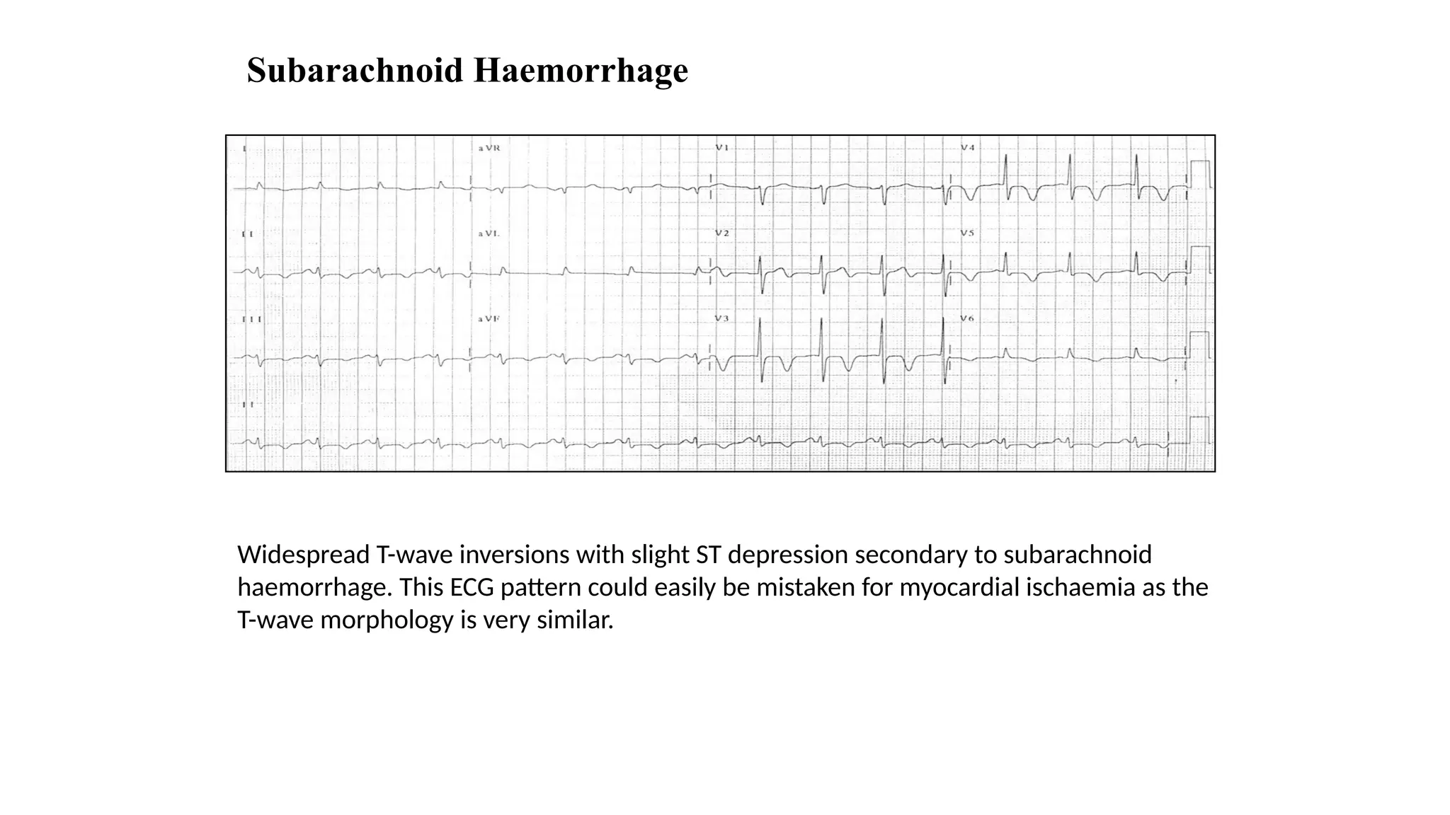 Ekg Changes In Electrolyte Abnormalities Pptx Ekg Changes In Electrolyte Abnormalities Pptx