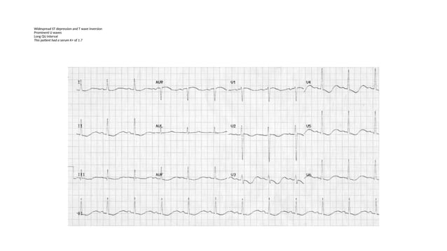 Ekg Changes In Electrolyte Abnormalities Pptx